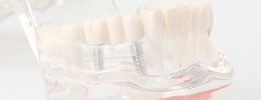 IMPLANT